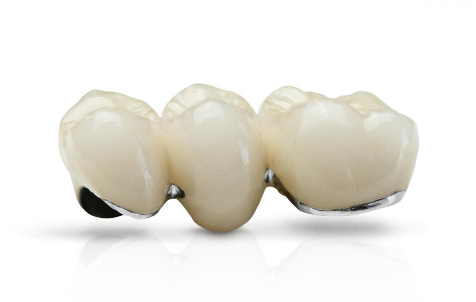 Как делают зубные коронки из металлокерамики?
