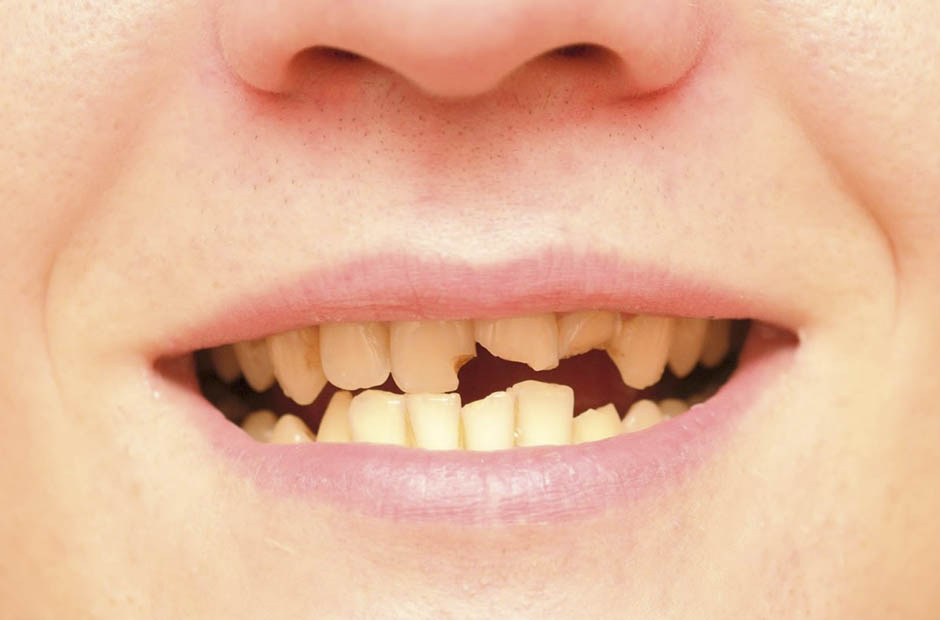Почему крошатся верхние и нижние зубы?