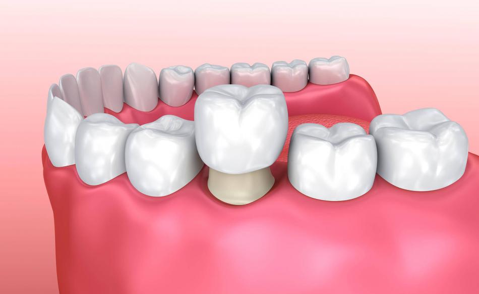 Какие коронки ставят на передние и жевательные зубы?