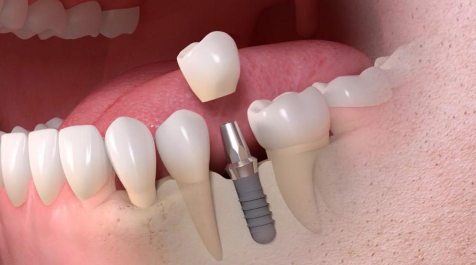 Сколько будет стоить одномоментная имплантация зубов?