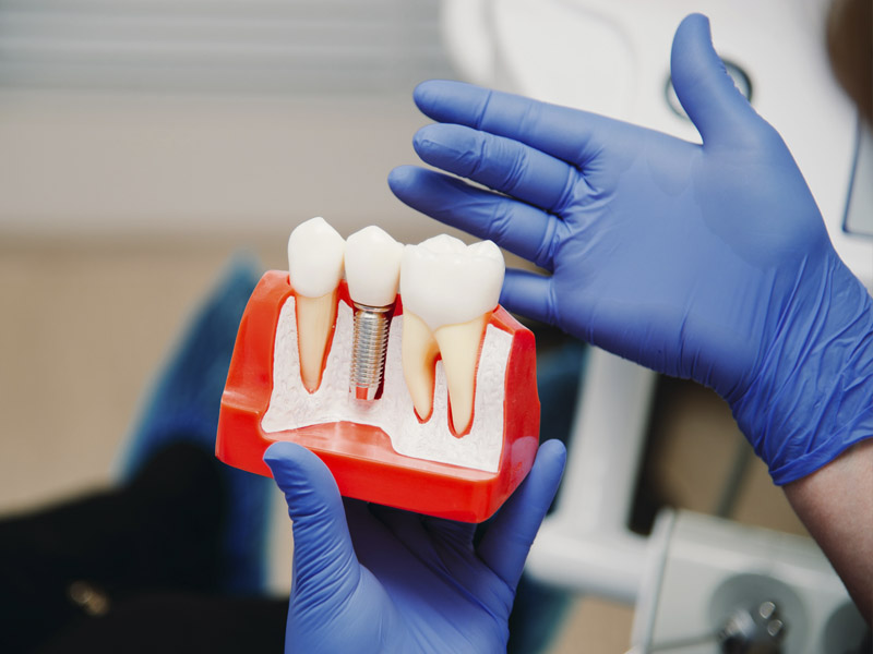 Консультация врача стоматолога-имплантолога.
