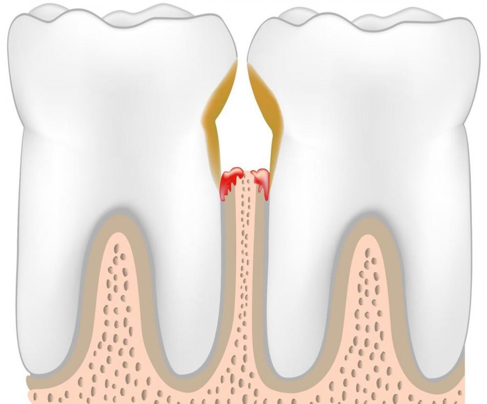 Кариес между зубами - признаки поражения эмали.
