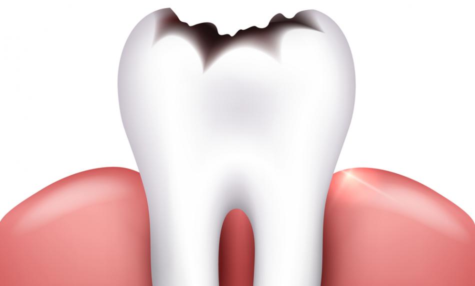 Сколько стоит лечение зуба в нижнем новгороде thumbnail
