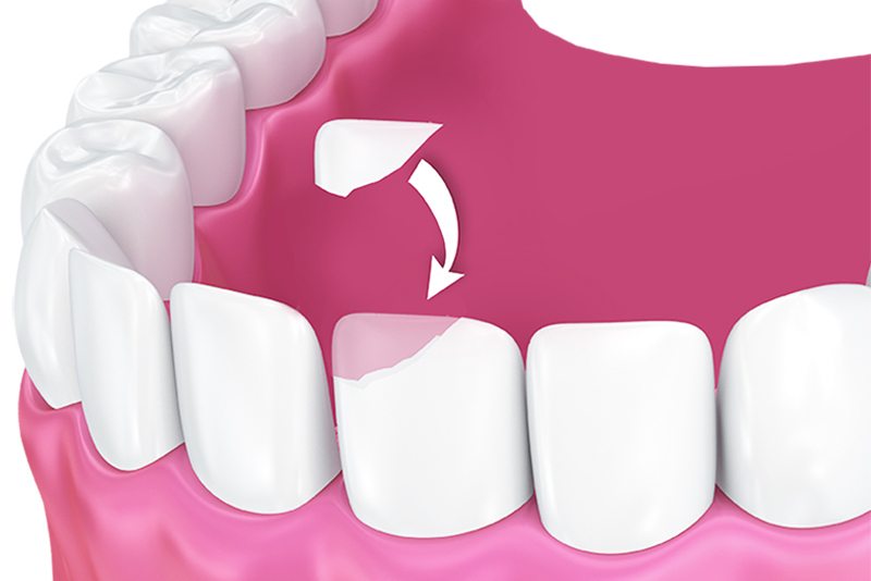 Стоимость восстановления зуба в стоматологии.